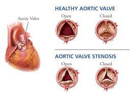 aortic_valve_stenosis.jpeg