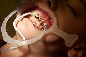 dental_mouth_retraction.jpg