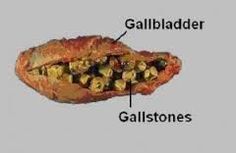 Gallbladder_gallstones.jpg