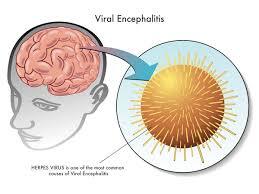 encephalitis.jpg