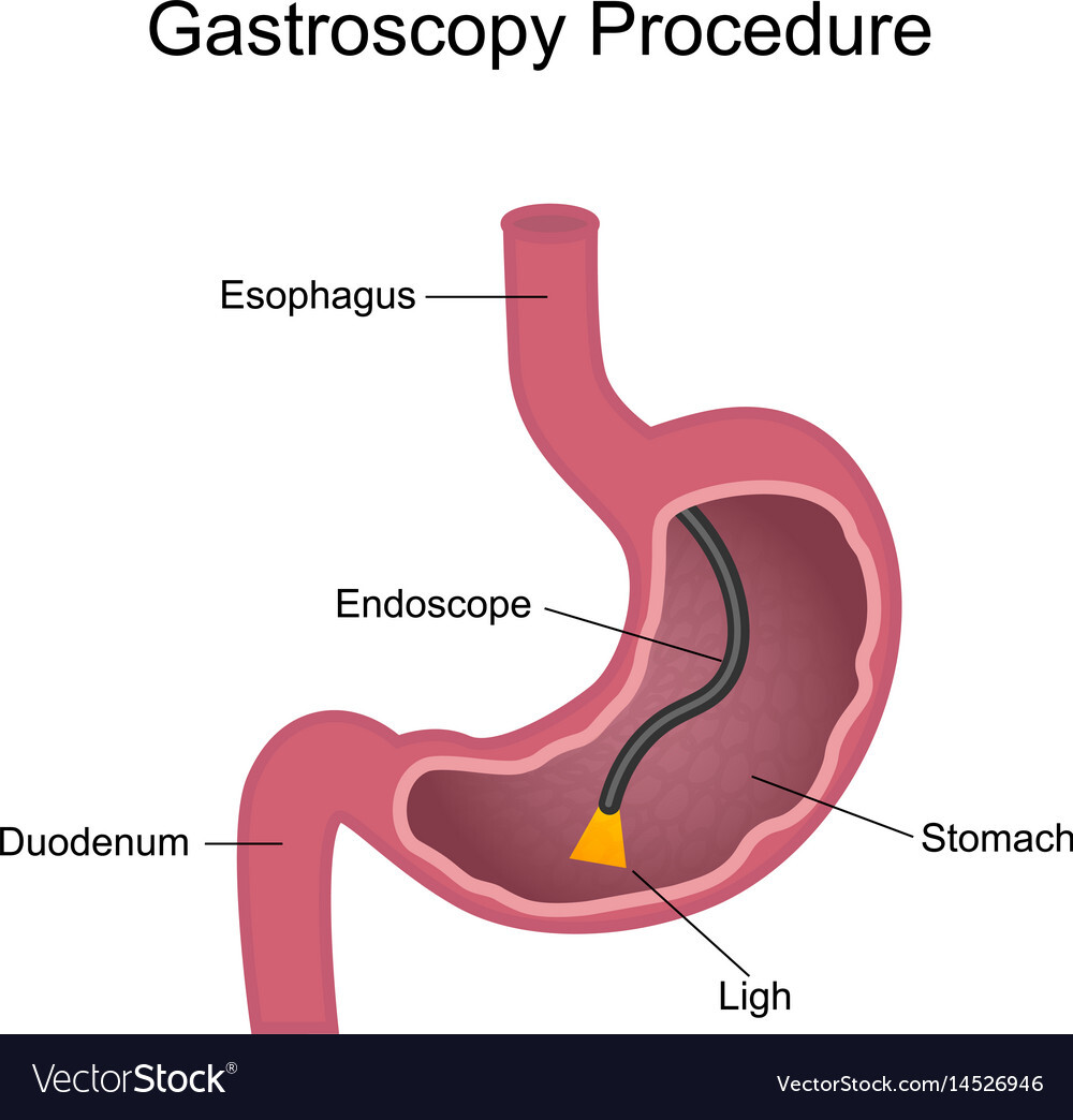 gastroscopy_procedure.jpg